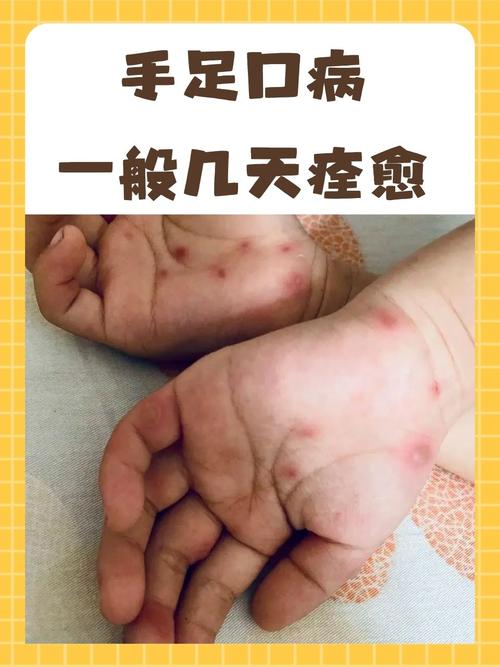 关于“水痘聚集性疫情定义”你不知道的事-第6张图片 关于“水痘聚集性疫情定义”你不知道的事-第6张图片